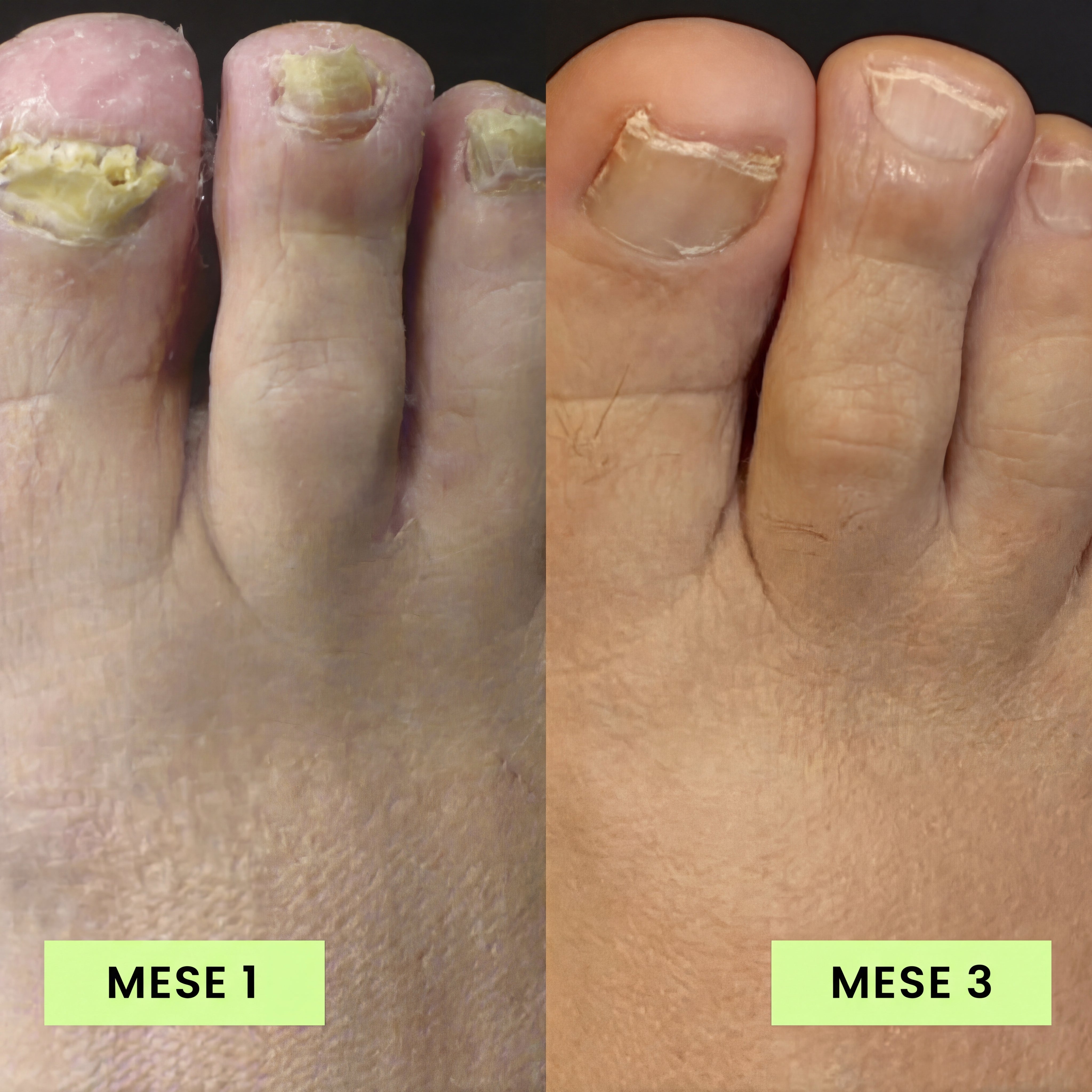Penna per la Cura delle Unghie Verdoria - Acido Undecilenico al 25% - VERDORIA