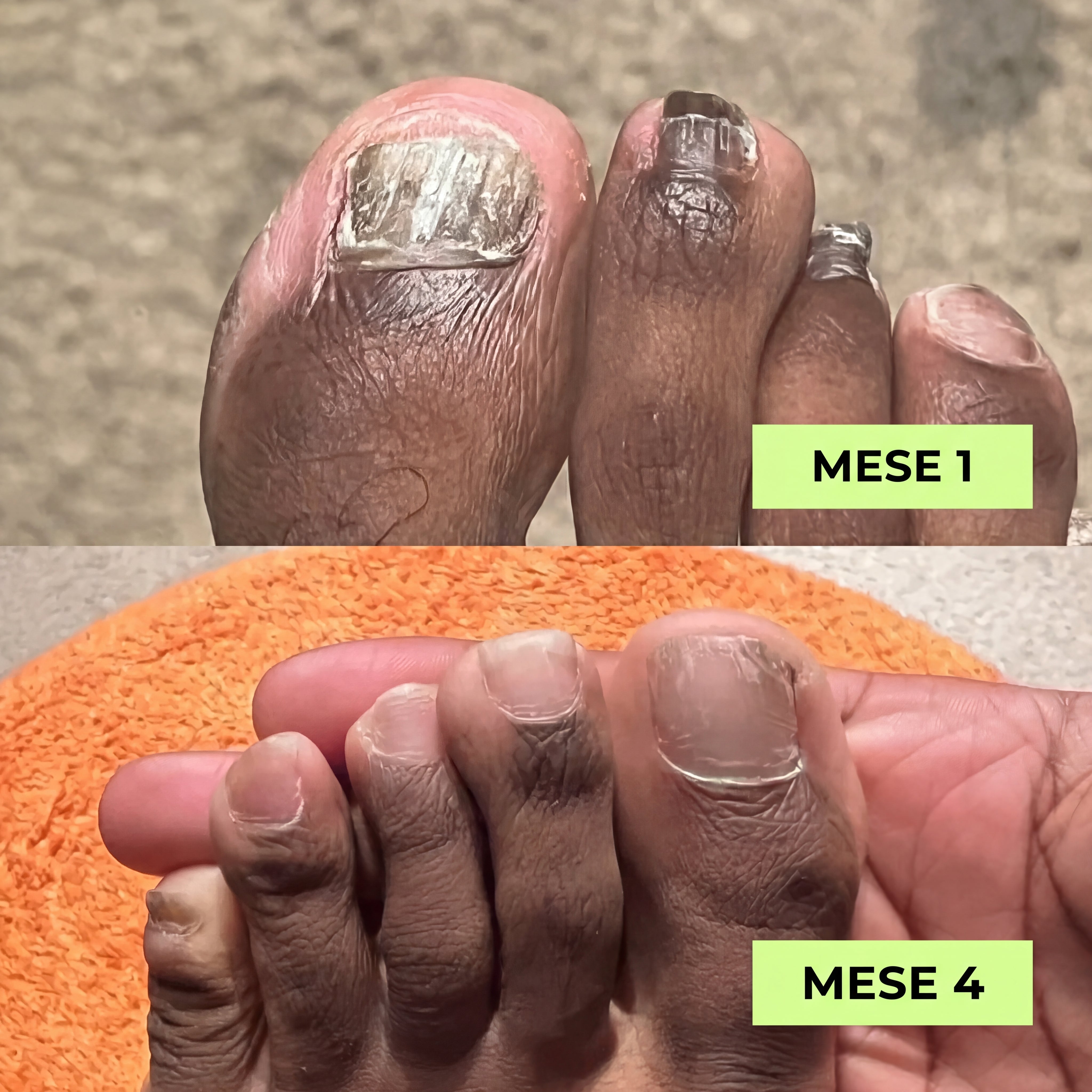 Penna per la Cura delle Unghie Verdoria - Acido Undecilenico al 25% - VERDORIA